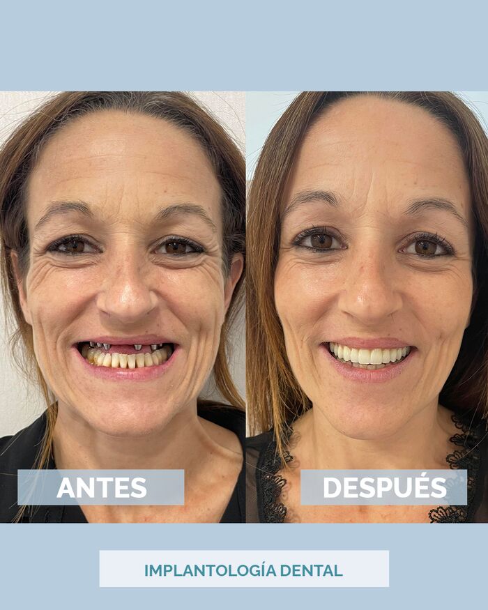 Antes y después de una rehabilitación dental en IMED Dental