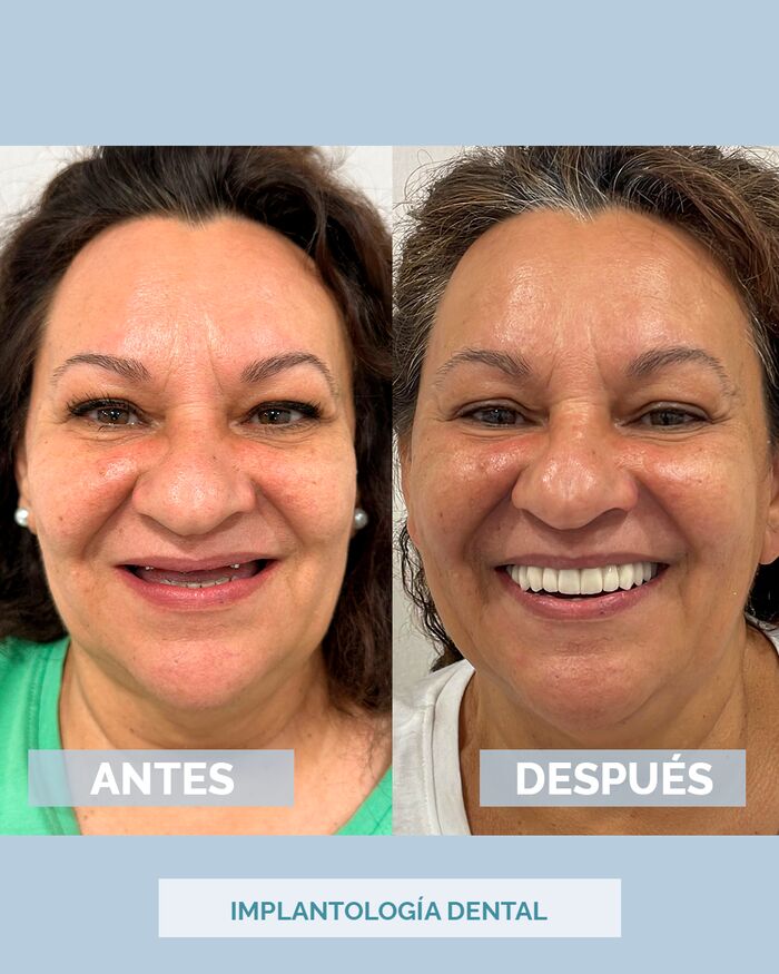 Antes y después de una rehabilitación dental en IMED Dental