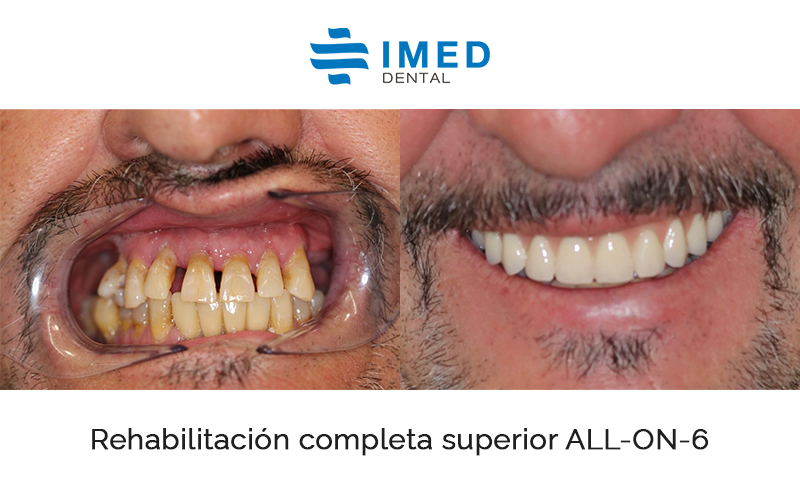Antes y después de una rehabilitación dental en IMED Dental