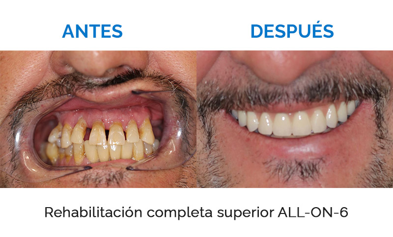 Antes y después de una rehabilitación dental en IMED Dental