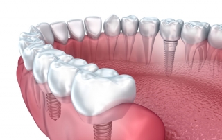 implantes dentales