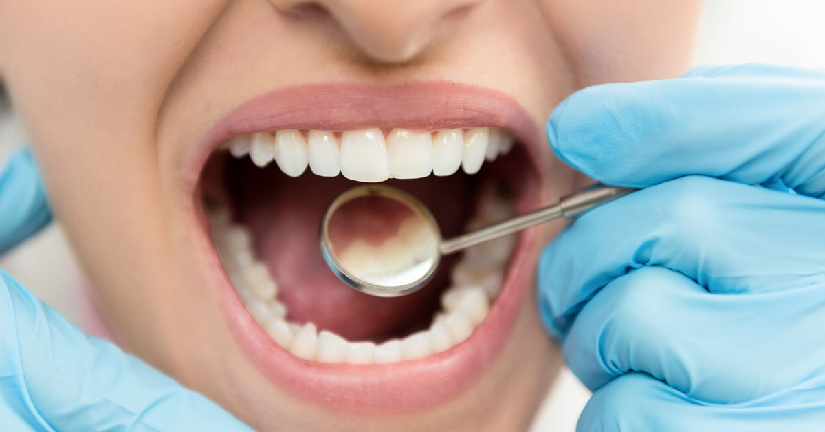 Caries: una de las principales enfermedades dentales - Clínica dental Belén Pérez