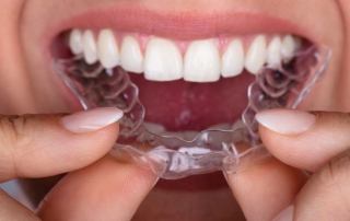 ¿Qué ortodoncia debo elegir para mis dientes?