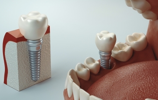 Qué son y para qué sirven los implantes dentales