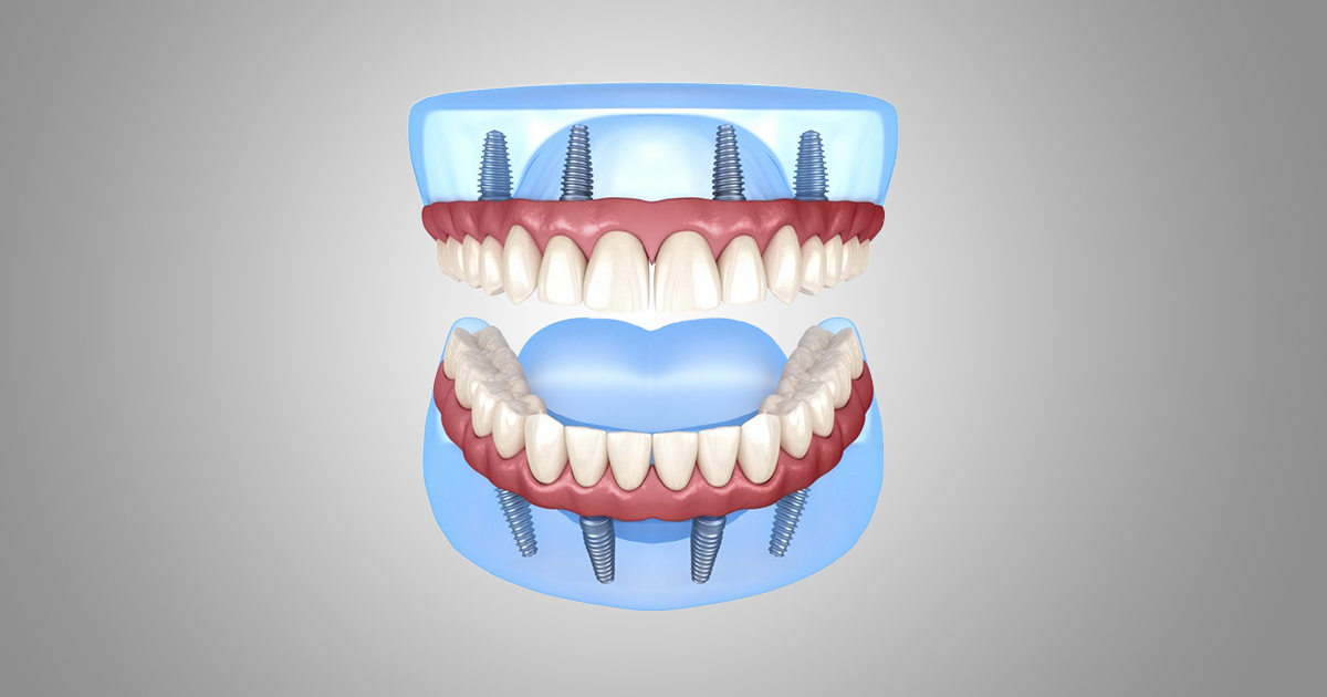 Qué son los implantes all on four IMED Dental