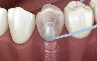 manera-de-limpiar-los-implantes-dentales
