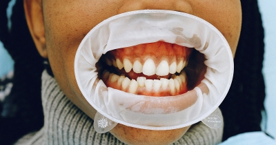 dientes-torcidos-solucion