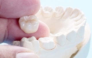 Diferencia entre carillas y coronas dentales
