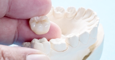 Diferencia entre carillas y coronas dentales